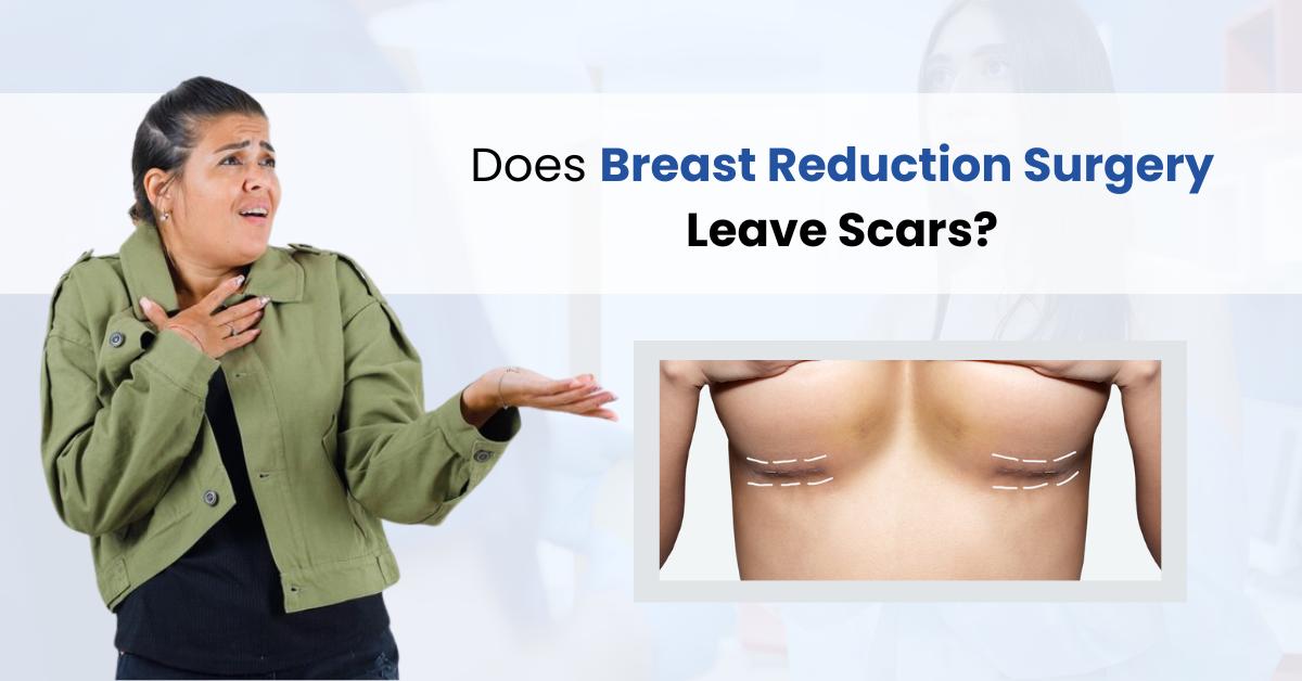 Does Breast Reduction Surgery Leave Scars